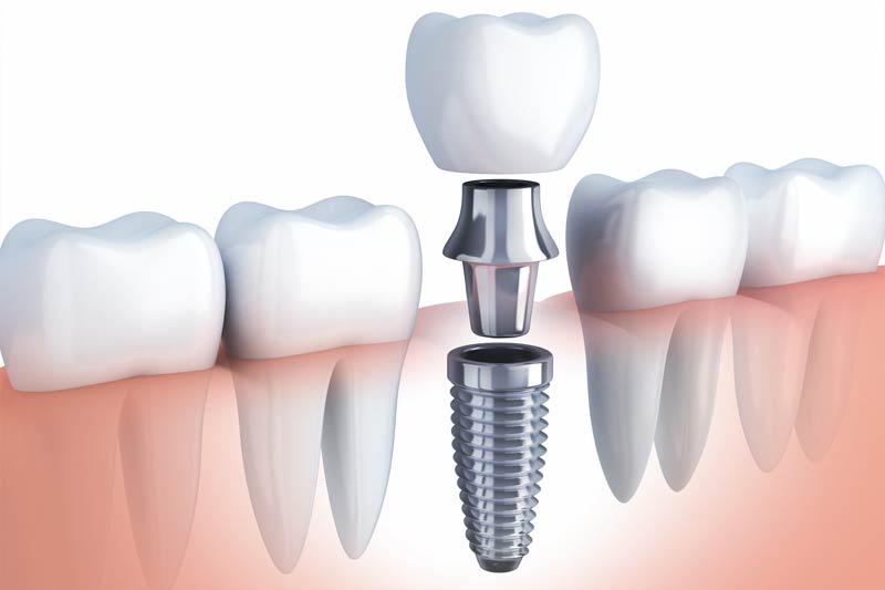 Implants Dentist in North Seattle