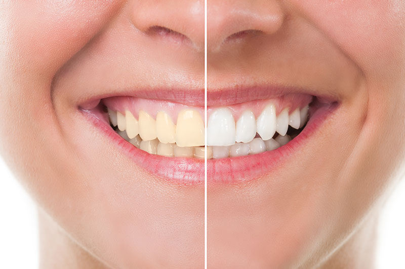 Teeth Whitening in North Seattle